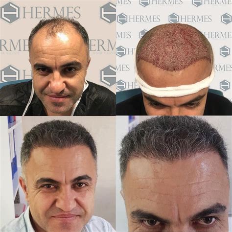 hermes hair clinic saç ekim merkezi istanbul|saç ekim merkezi istanbul.